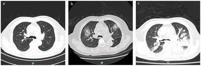 Clinical characteristics and risk factors associated with diverse manifestations of COVID-19 in patients aged 85 years and older